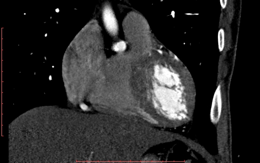 Anomalous left coronary artery from the pulmonary artery (ALCAPA) (Radiopaedia 70148-80181 B 95).jpg