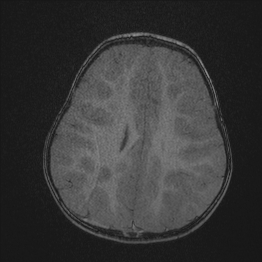 Anoxic brain injury (Radiopaedia 79165-92139 Axial MRA 176).jpg