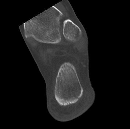 Anterior calcaneal process fracture (Radiopaedia 47384-51989 Coronal bone window 69).png