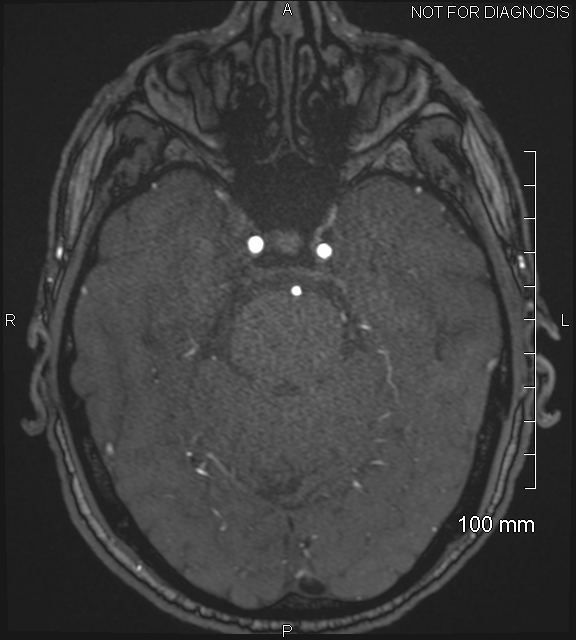Anterior cerebral artery aneurysm (Radiopaedia 80683-94127 Axial MRA 75).jpg
