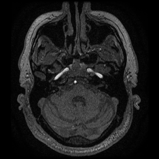 Anterior cerebral artery infarction (Radiopaedia 46794-51323 Axial MRA 25).jpg