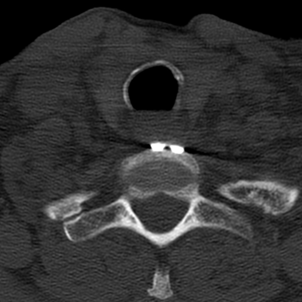 Anterior cervical postdiscectomy arthrodesis (Radiopaedia 32678-33646 Axial bone window 64).jpg