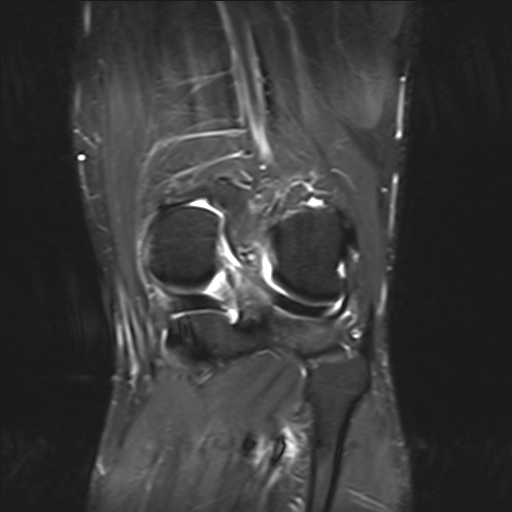 File:Anterior cruciate ligament full thickness tear (Radiopaedia 66268-75467 Coronal STIR 15).jpg