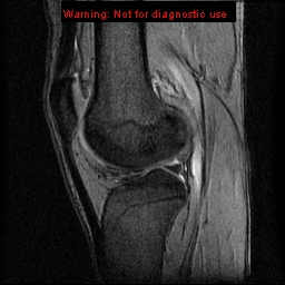 File:Anterior cruciate ligament injury - partial thickness tear (Radiopaedia 12176-12515 A 12).jpg