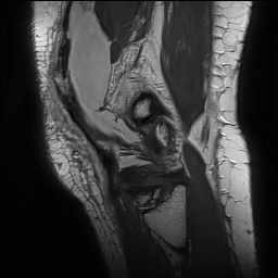 Anterior cruciate ligament rupture with Segond fracture (Radiopaedia 69043-78806 Sagittal PD 159).jpg