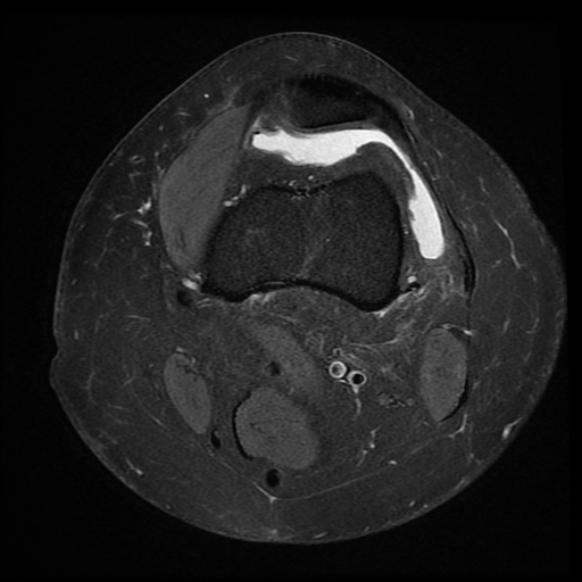 File:Anterior cruciate ligament tear, Wrisberg rip and bucket-handle tear of medial meniscus (Radiopaedia 75872-87266 Axial PD fat sat 23).jpg