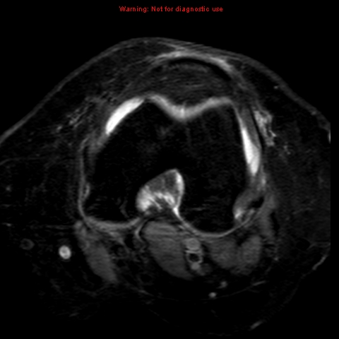 File:Anterior cruciate ligament tear (Radiopaedia 12329-12612 Axial T2 fat sat 12).jpg