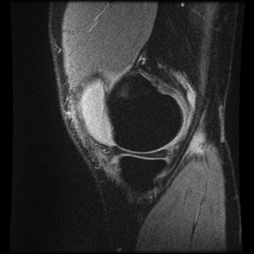 Anterior cruciate ligament tear (Radiopaedia 61500-69462 F 12).jpg