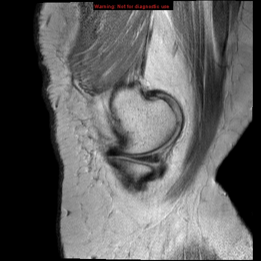 File:Anterior cruciate ligament tear - complete (Radiopaedia 12175-12514 Sagittal PD 18).jpg