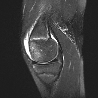 File:Anterior cruciate ligament tear - pediatric (Radiopaedia 62152-70260 Sagittal PD fat sat 12).jpg