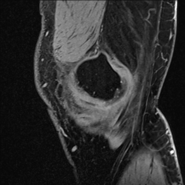 Anterior cruciate ligament tear - ramp lesion (Radiopaedia 71883-82322 Sagittal T1 vibe 121).jpg