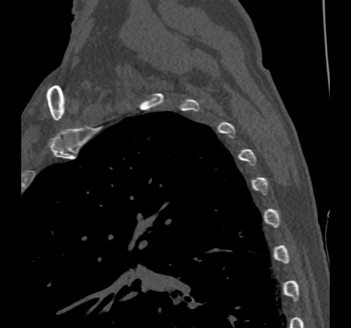 Anterior glenohumeral dislocation with Hill-Sachs lesion (Radiopaedia 62877-71249 Sagittal bone window 64).jpg