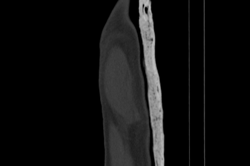 Anterior inferior iliac spine avulsion injury (Radiopaedia 88666-105376 Sagittal bone window 7).jpg