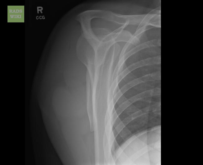 File:Anterior shoulder dislocation (Radiopaedia 11194-39053 Lateral 1).jpg