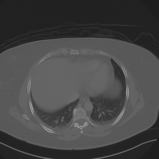 Anterior superior iliac spine avulsion fracture (Radiopaedia 44541-48244 Axial bone window 9).png