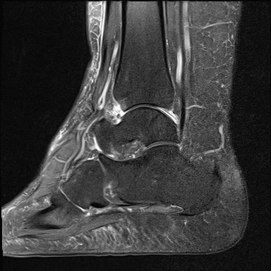 File:Anterior talofibular ligament injury - rupture with soft-tissue impingement (Radiopaedia 38765-40928 Sagittal PD fat sat 10).jpg