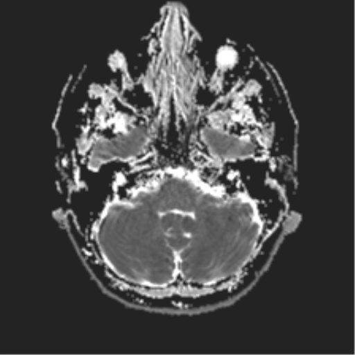 File:Anterior temporal lobe perivascular space (Radiopaedia 40946-43650 Axial ADC 5).png