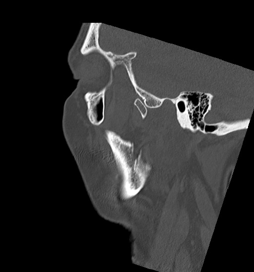 Anterior temporomandibular joint dislocation (Radiopaedia 59430-66784 B 10).jpg