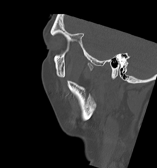 Anterior temporomandibular joint dislocation (Radiopaedia 59430-66784 B 53).jpg