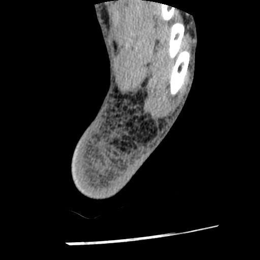 Anterior tibial artery false aneurysm (Radiopaedia 88984-105809 A 248).jpg