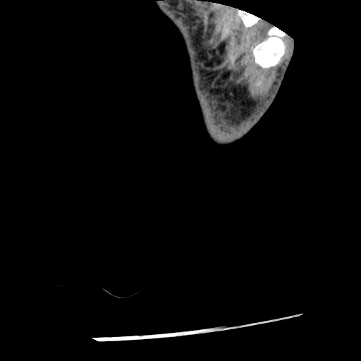 Anterior tibial artery false aneurysm (Radiopaedia 88984-105809 A 273).jpg