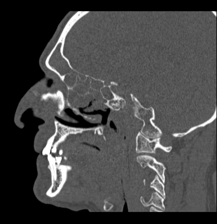Antrochoanal polyp (Radiopaedia 79011-92169 Sagittal bone window 44).jpg