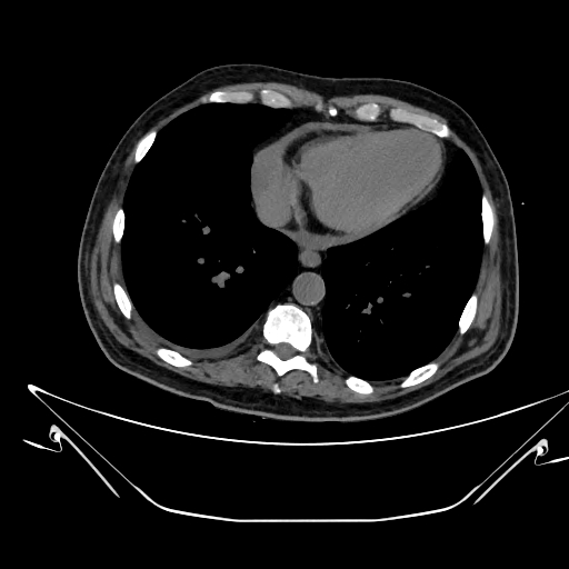 Aortic arch aneurysm (Radiopaedia 84109-99365 Axial non-contrast 202).jpg