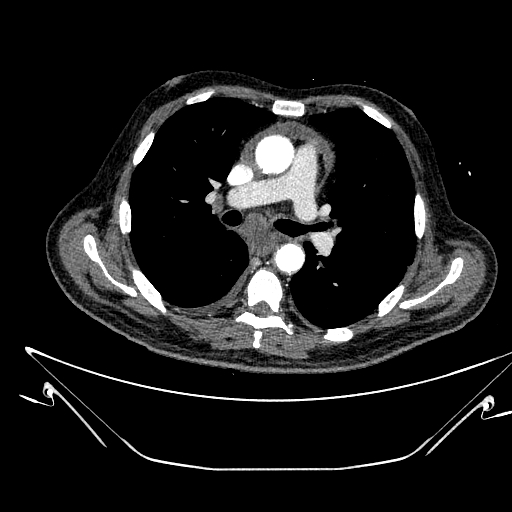 Aortic arch aneurysm (Radiopaedia 84109-99365 B 286).jpg