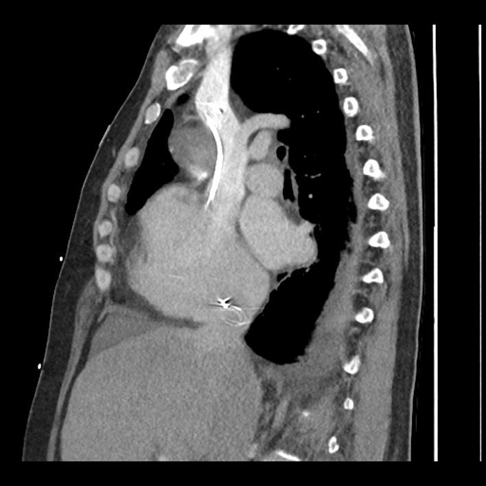Aortic arch graft infection (FDG PET-CT) (Radiopaedia 71975-82437 C 27).jpg