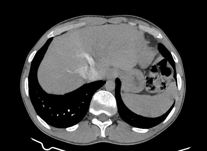 File:Aortic coarctation with aneurysm (Radiopaedia 74818-85828 A 47).jpg
