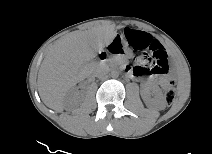 File:Aortic coarctation with aneurysm (Radiopaedia 74818-85828 A 7).jpg