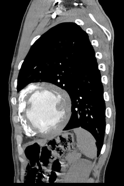 Aortic coarctation with aneurysm (Radiopaedia 74818-85828 B 126).jpg