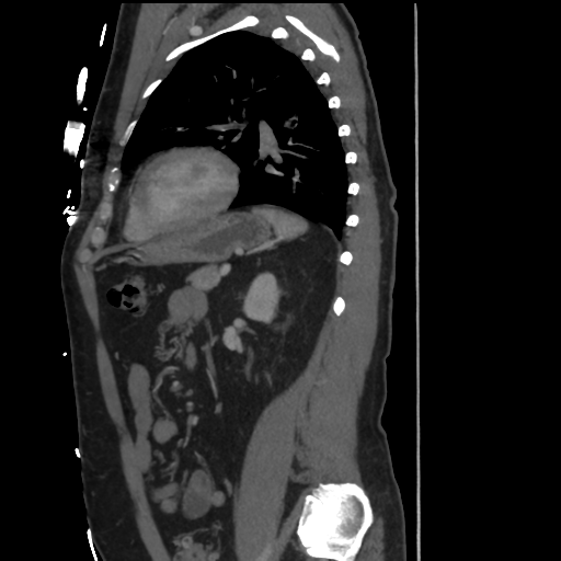 File:Aortic dissection- Stanford A (Radiopaedia 37759-39664 Sagittal C+ delayed 32).png