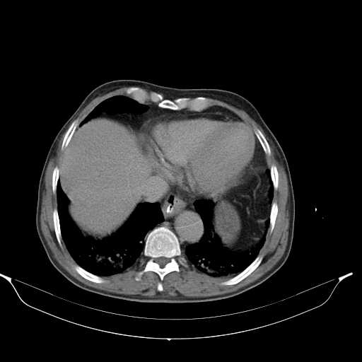 File:Aortic dissection- Stanford type A (Radiopaedia 22085-22085 Axial C+ delayed 5).jpg