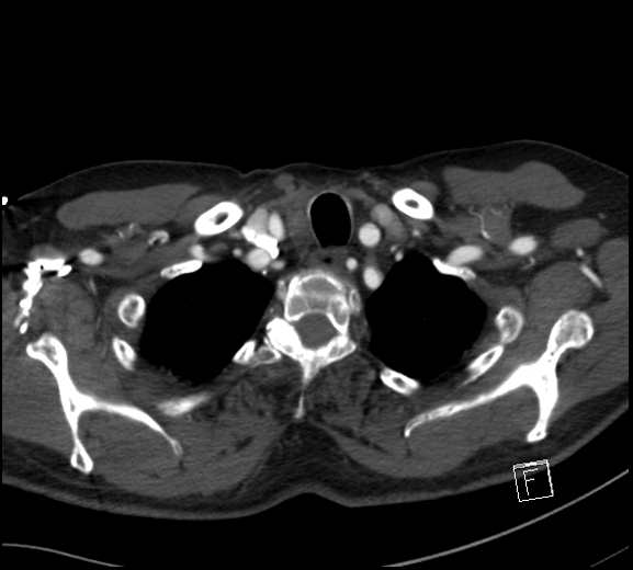 File:Aortic dissection (CTPA) (Radiopaedia 75506-86750 A 10).jpg