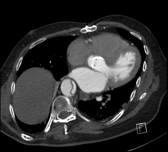 File:Aortic dissection (CTPA) (Radiopaedia 75506-86750 A 59).jpg