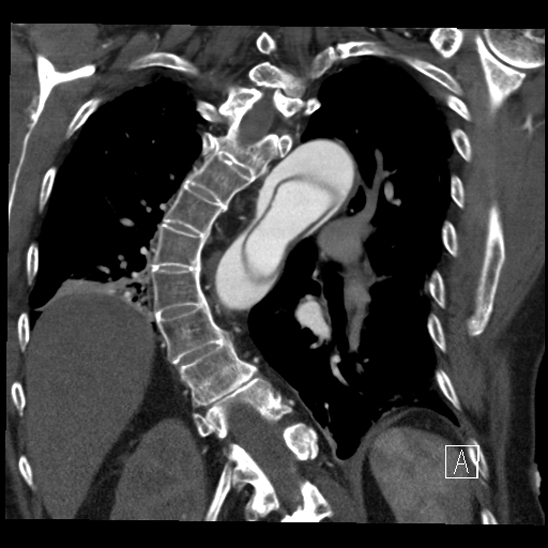 File:Aortic dissection (CTPA) (Radiopaedia 75506-86750 B 53).jpg