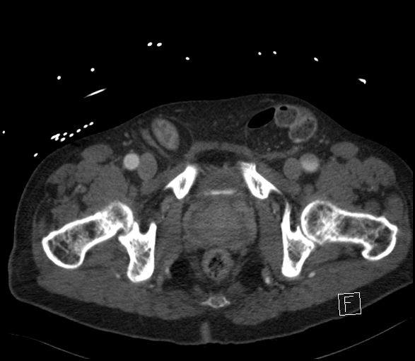 Aortic dissection (CTPA) (Radiopaedia 75506-86750 E 150).jpg