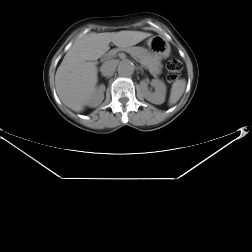 Aortic dissection (Radiopaedia 25350-25604 B 44).jpg