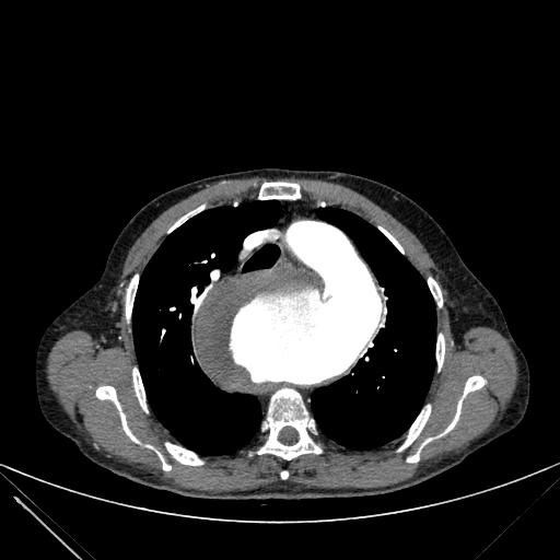 Aortic dissection (Radiopaedia 27466-27665 C+ arterial phase 62).jpg