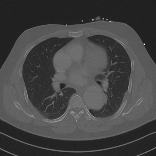 Aortic dissection (Radiopaedia 50763-56234 Axial bone window 54).png