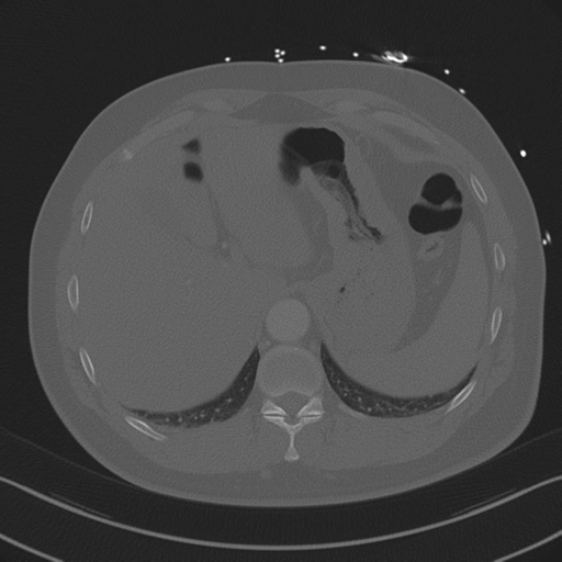 File:Aortic dissection (Radiopaedia 50763-56234 Axial bone window 91).png
