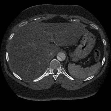 Aortic dissection (Radiopaedia 57969-64959 A 294).jpg