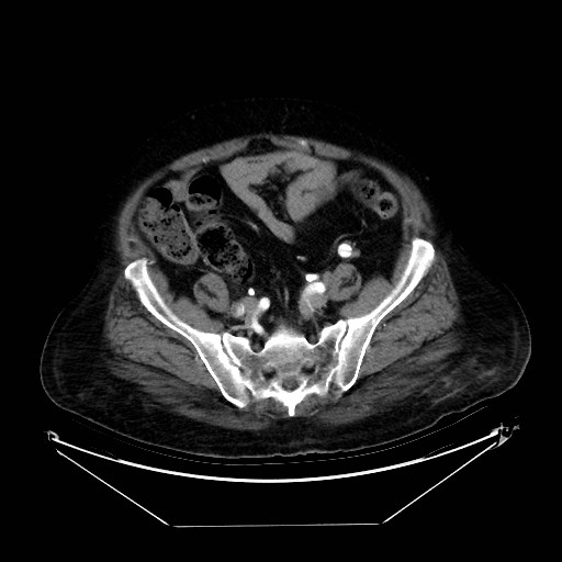 Aortic dissection (Radiopaedia 62562-71000 A 92).jpg