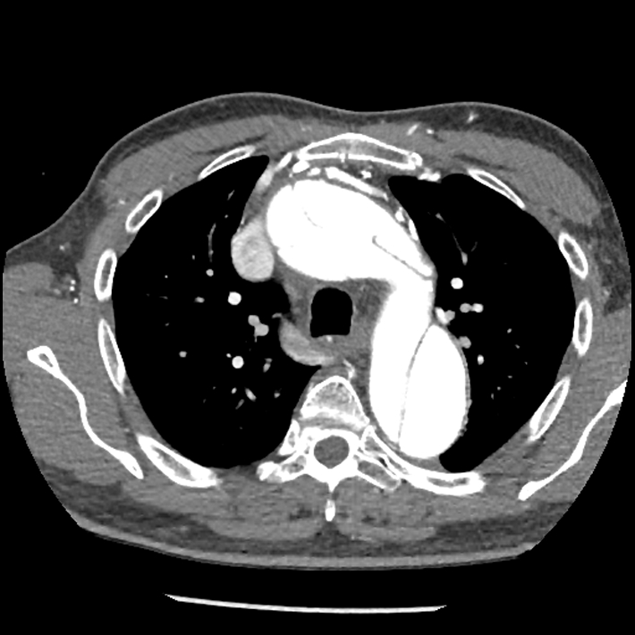 Aortic dissection - DeBakey Type I-Stanford A (Radiopaedia 79863-93115 A 11).jpg