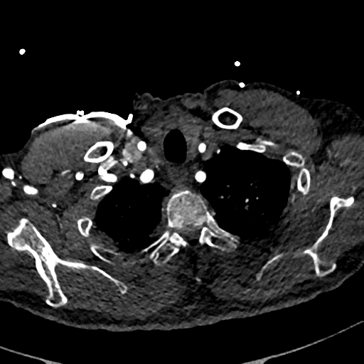 Aortic dissection - DeBakey type II (Radiopaedia 64302-73082 A 12).png