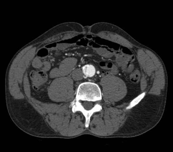 Aortic dissection - Stanford type B (Radiopaedia 73648-84437 A 190).jpg