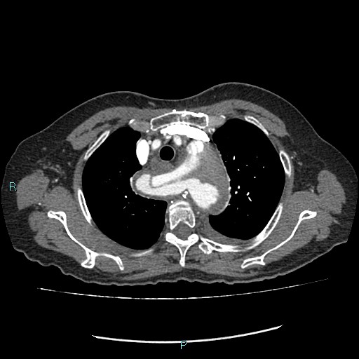 File:Aortic dissection extended to lusory artery (Radiopaedia 43686-47136 B 3).jpg
