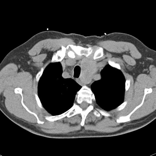 Aortic intramural hematoma (Radiopaedia 31139-31838 Axial non-contrast 10).jpg