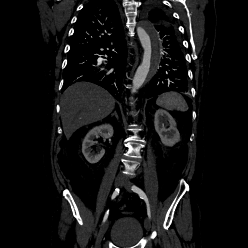 Aortic intramural hematoma (Radiopaedia 34260-35540 C 57).png